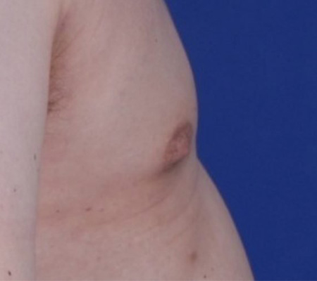 Male Gynecomastia Vaser Lipo After